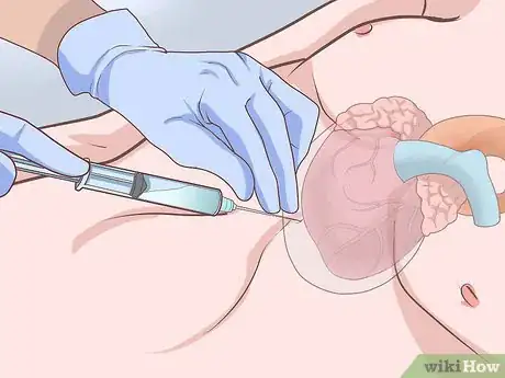 Image titled Treat Obstructive Shock Step 8