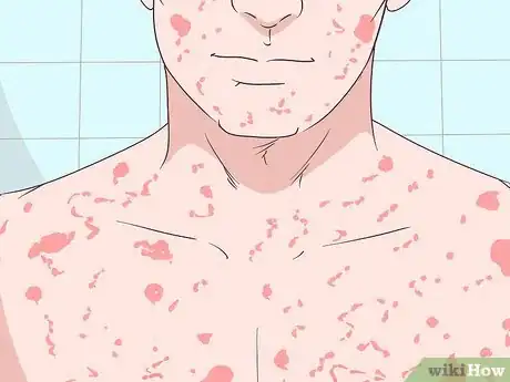 Image titled Recognize Signs and Symptoms of Ebola Step 8