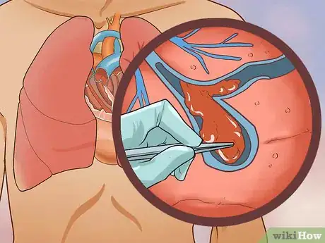 Image titled Treat Obstructive Shock Step 6