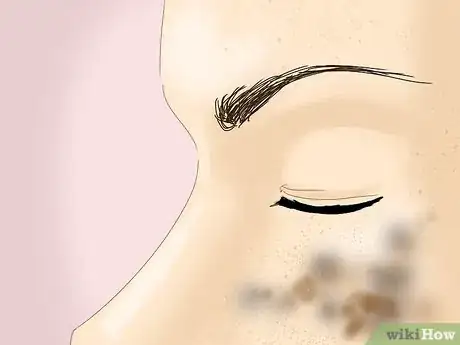 Image titled Prevent Hyperpigmentation of the Skin Step 2
