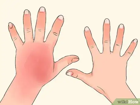 Image titled Diagnose Osteoarthritis Step 3