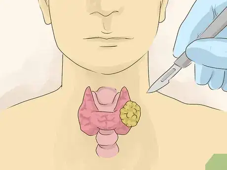 Image titled Treat Hyperthyroidism in Men Step 10