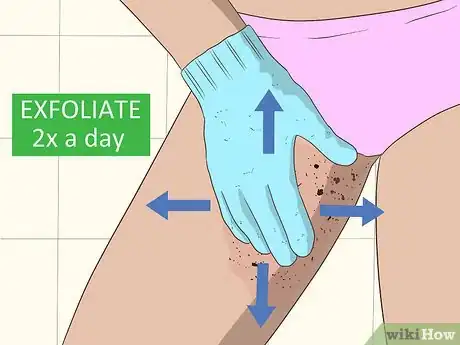 Image titled Remove an Ingrown Hair Step 4