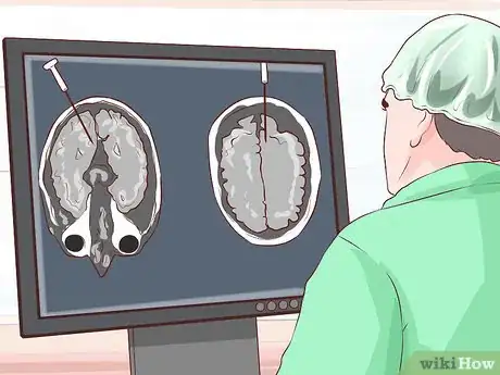 Image titled Diagnose Astrocytoma Step 8