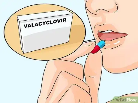 Image titled Recognize Herpes Step 7