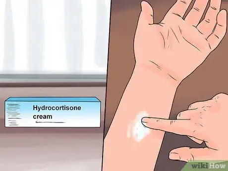 Image titled Treat Winter Eczema Step 3