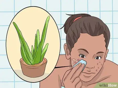 Image titled Bring a Blind Pimple to a Head Step 7