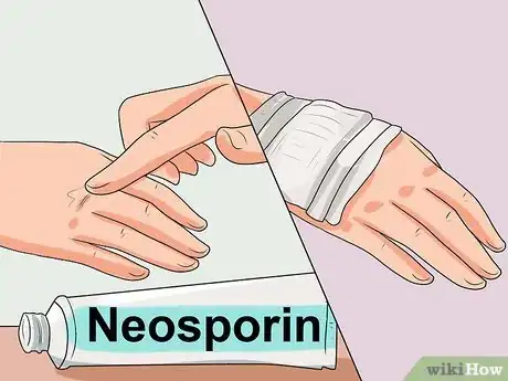 Image titled Treat a Hot Water Spill on Your Skin Step 9