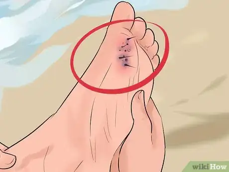 Image titled Identify and Treat Injuries From Stingrays and Sea Urchins Step 12