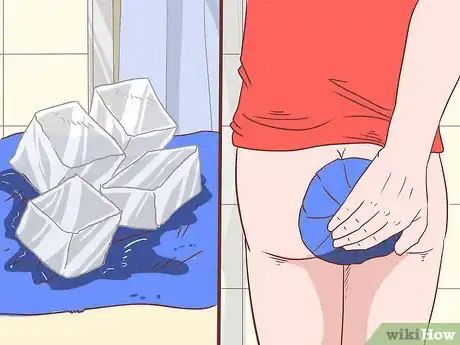 Image titled Care for Hemorrhoids Postpartum Step 5