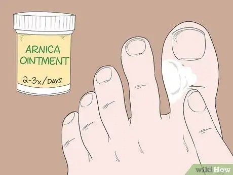 Image titled Heal a Bruised Toe Step 8
