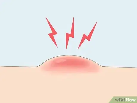 Image titled Prevent Cystic Acne Step 1