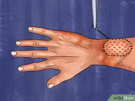 Image titled Activate Your Own Stem Cells Step 09