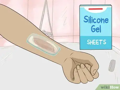 Image titled Get Rid of Burn Scars Step 4