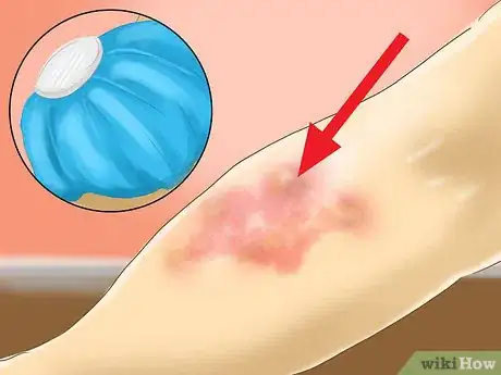 Image titled Treat Vibration Induced Hives Step 3