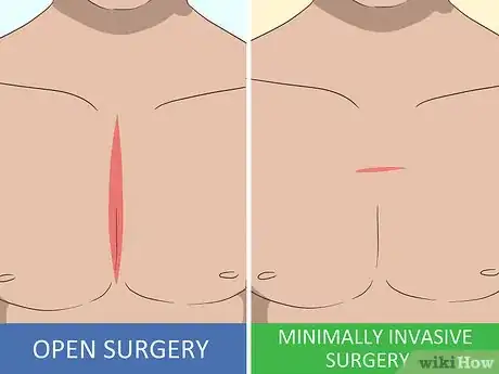 Image titled Treat Myasthenia Gravis Step 9