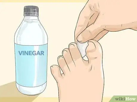 Image titled Get Rid of Calluses Step 10