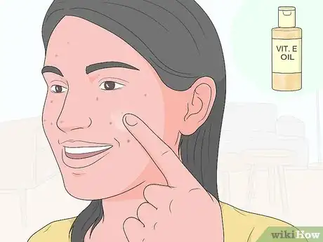 Image titled Get Rid of Acne Scars at Home Without Chemicals Step 3