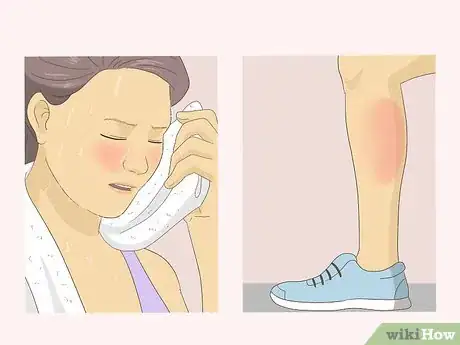 Image titled Treat Hyperthermia Step 1