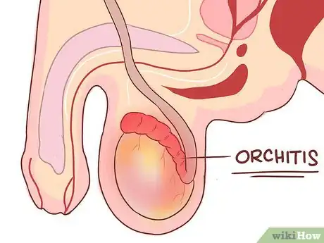Image titled Treat Pain and Swelling in the Testicles Step 8