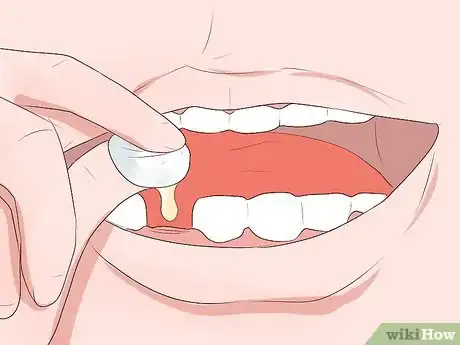 Image titled Take Care of Your Loose Teeth Step 12