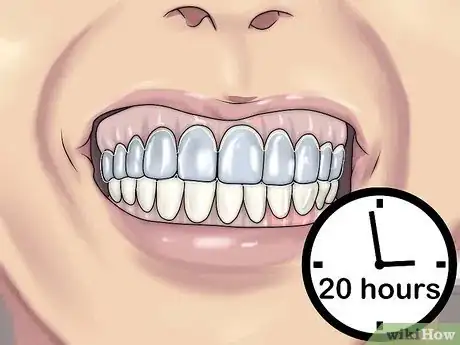 Image titled Get Straight Teeth Without Braces with Invisalign Step 8