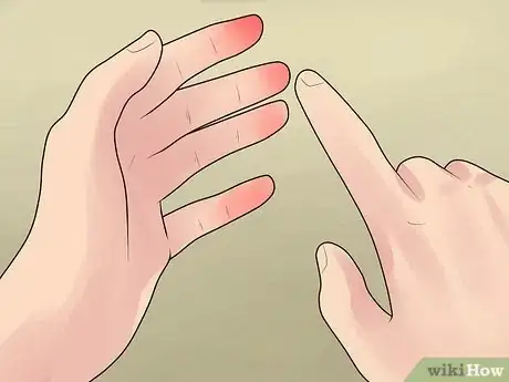 Image titled Heal Skin Damage from Frostbite Step 15