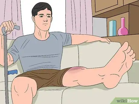 Image titled Care for a Bruise Naturally Step 5