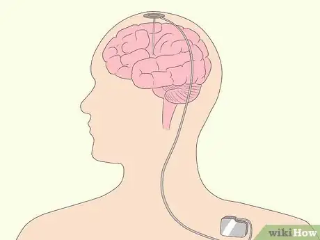 Image titled Treat Neurological Disorders Step 19