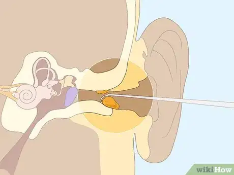 Image titled Help Tinnitus at Night Step 9