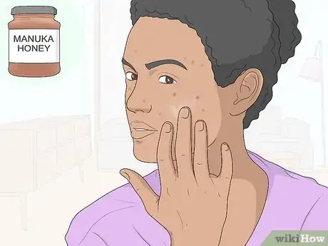 Image titled Get Rid of Acne Scars at Home Without Chemicals Step 5