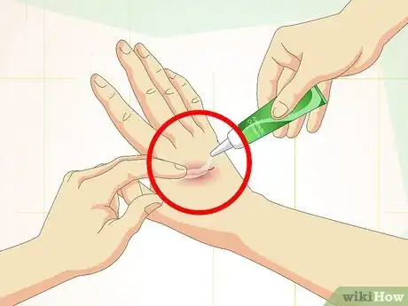 Image titled Care for Superficial Wounds Step 4