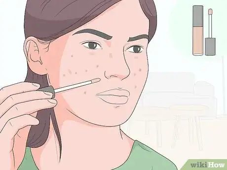 Image titled Get Rid of Acne Scars at Home Without Chemicals Step 6