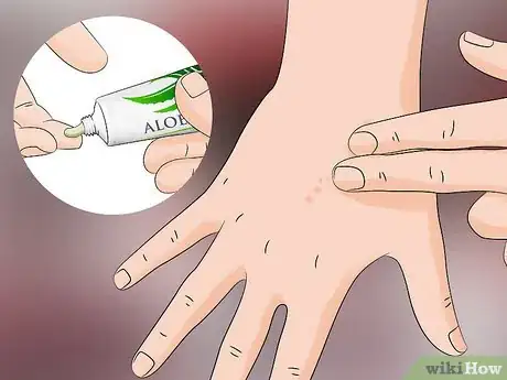 Image titled Treat Sand Flea Bites Step 6