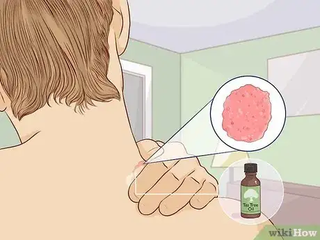 Image titled Treat Skin Conditions with Tea Tree Oil Step 10