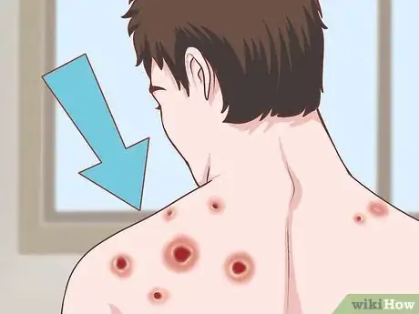 Image titled Handle a Rheumatoid Arthritis Skin Problem Step 3