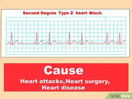 Image titled Identify Heart Blocks Step 11