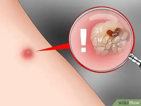 Image titled Treat Sand Flea Bites Step 8