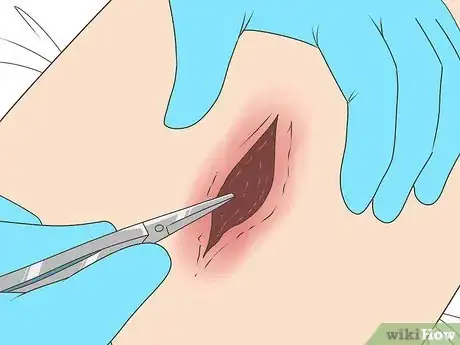 Image titled Know if a Wound Is Healing Step 15