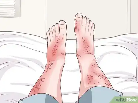 Image titled Handle a Rheumatoid Arthritis Skin Problem Step 2