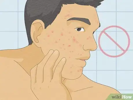 Image titled Be Confident If You Have Acne Step 17