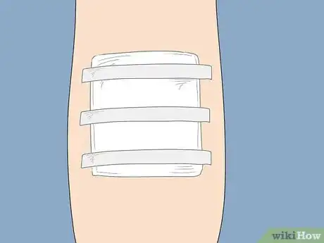 Image titled Know if a Wound Is Healing Step 12