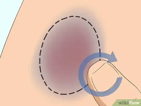 Image titled Make a Bruise Go Away Faster Step 5