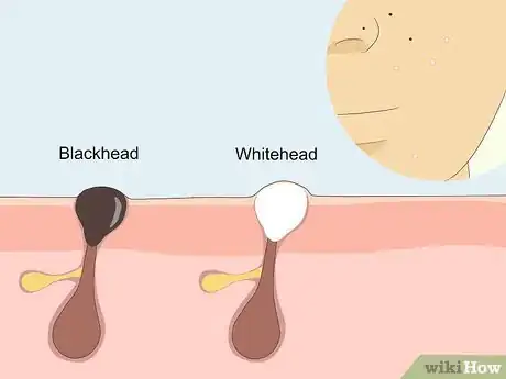 Image titled Treat Adult Acne Step 12