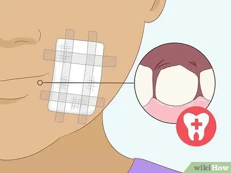 Image titled Pull a Loose Tooth at Home Step 16