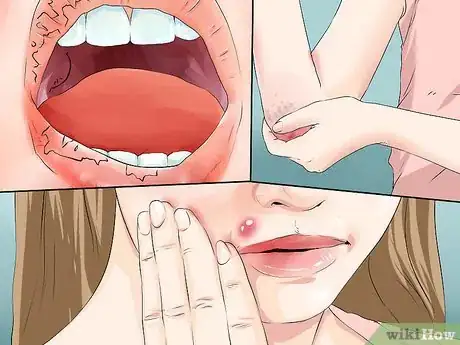 Image titled Prevent Squamous Cell Skin Cancer Step 13