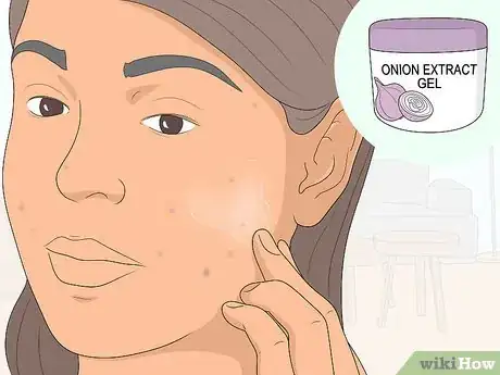 Image titled Get Rid of Acne Scars at Home Without Chemicals Step 1