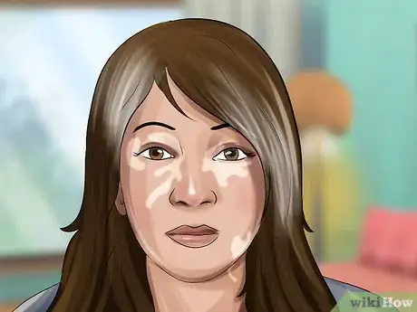 Image titled Diagnose Vitiligo Step 1