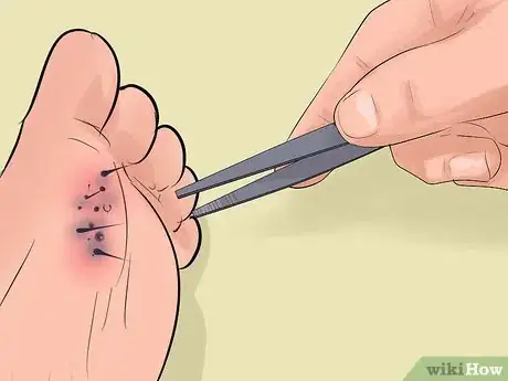 Image titled Identify and Treat Injuries From Stingrays and Sea Urchins Step 17