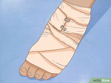 Image titled Apply Different Types of Bandages Step 10